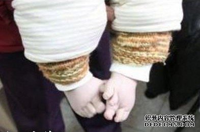 畸形婴儿 有数小孩出生有12个手指