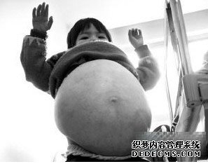 有数的大肚病熬煎着可怜的小孩