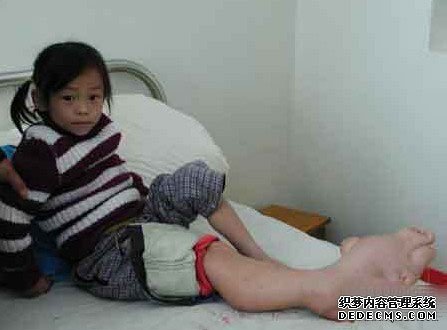 有数的大肚病熬煎着可怜的小孩